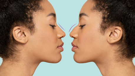 London, Health, Non-Surgical Rhinoplasty &ndash; Smooth, Shape & Enhance Your Nose Instantly