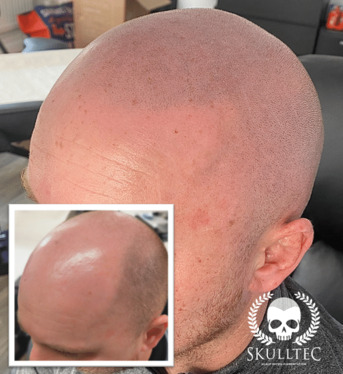 London, Health, Expert Scalp Micropigmentation In Glasgow | Skulltec