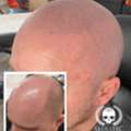 Expert Scalp Micropigmentation In Glasgow | Skulltec