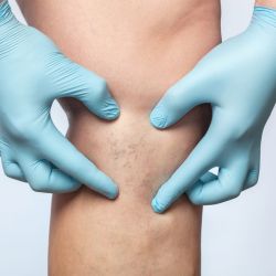 New York, Beautician, Effective Spider Veins Treatments Fort Collins | Smooth Skin Solutions