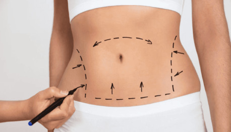 Mumbai, Health, Affordable Tummy Tuck Surgery In Mumbai &ndash; Limited Time Offer