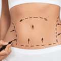 Affordable Tummy Tuck Surgery In Mumbai &ndash; Limited Time Offer