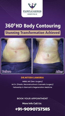 Jaipur, Health, Best Liposuction Surgeon In Jaipur - Dr. Nitesh Lamoria