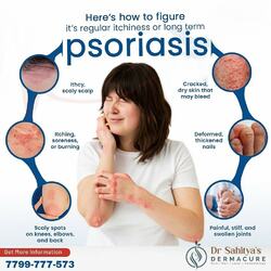 Kurnool, Health, Psoriasis Signs And Management- Dermacure