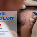 Best Clinic For FUE Hair Transplant In Gurgaon | SB Trichology