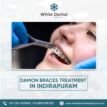 Ghaziabad, Dental, Best Damon Braces Treatment In Indirapuram
