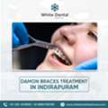 Best Damon Braces Treatment In Indirapuram