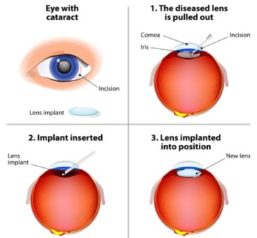 Dubai, Health, Cataract Surgeon In Dubai For Clear Vision Results