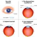 Cataract Surgeon In Dubai For Clear Vision Results