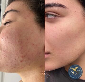 Sydney, Education, What Do SQT Bio Microneedling Before And After Show?