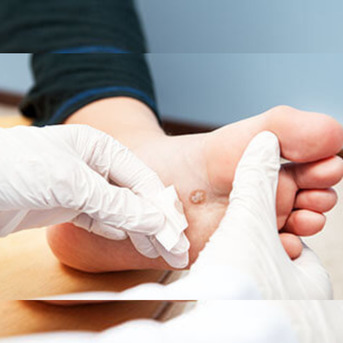 Houston, Medical, Effective Plantar Warts Treatment In Houston