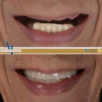 Male, Dental, Scared Of Pain? Dental Implants Are Easier Than You Think