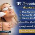 Professional IPL Photofacial Aurora Treatment Near You