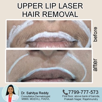 Kurnool, Health, Best Results For Upper Lip Hair - Dermacure
