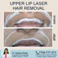 Best Results For Upper Lip Hair - Dermacure