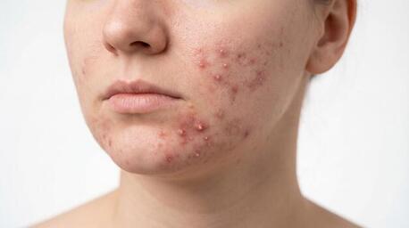 New York, Health, Deep Cleansing Solution For Breakout-Prone Skin