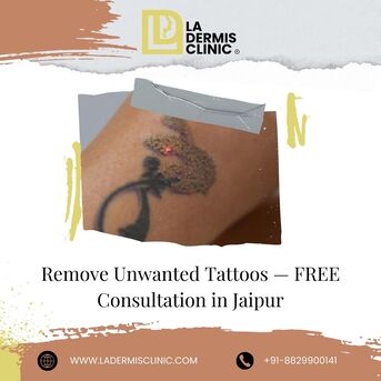 Jaipur, Health, Remove Unwanted Tattoos &mdash; FREE Consultation In Jaipur