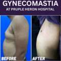 Best Gynecomastia Surgeon In Jaipur - Dr. Nitesh Lamoria