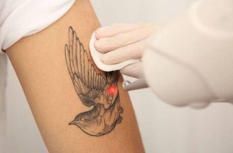 New Delhi, Medical, Safe Tattoo Removal Clinic In Ashok Vihar, Delhi Today