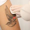 Safe Tattoo Removal Clinic In Ashok Vihar, Delhi Today