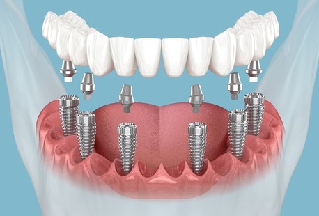 Ahmedabad, Dental, Dental Implants In Ahmedabad For NRIs | The Dental Wellness Centre