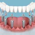 Dental Implants In Ahmedabad For NRIs | The Dental Wellness Centre