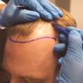 Best Hair Transplant Turkey - Affordable & Natural Results