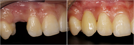 New York, Dental, Advanced Implant Dentistry For Missing Teeth - Dublin Metro Dental