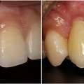 Advanced Implant Dentistry For Missing Teeth - Dublin Metro Dental