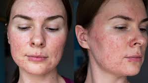 New York, Health, Deep Clean For Acne-Prone Skin