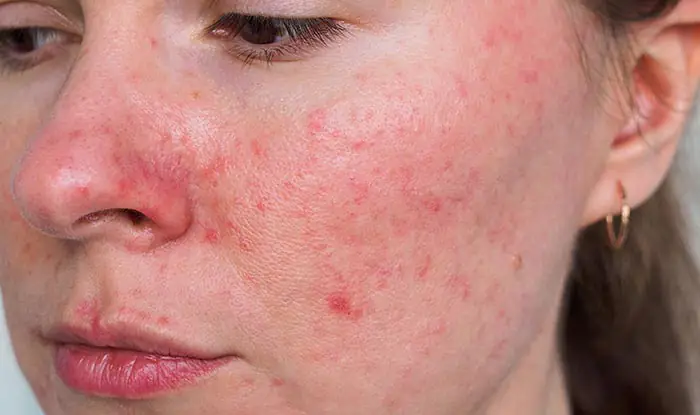 New York, Health, Targeted Care For Post-Acne Marks