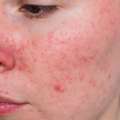 Targeted Care For Post-Acne Marks