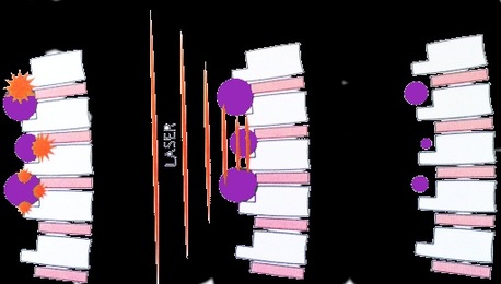 New York, Health, Best Multi Wavelength Laser For Physiotherapy Pain Relief Care