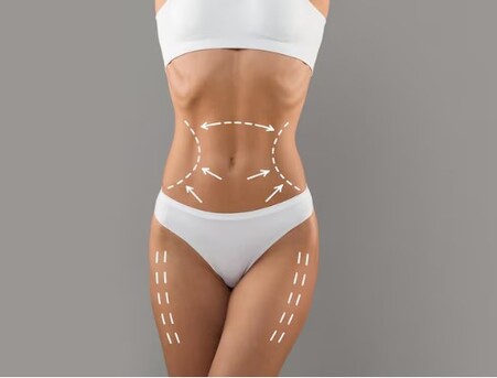 Cape Town, Health, Liposuction In Cape Town For Safe & Effective Body Contouring