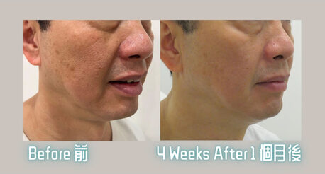 Toronto, Beautician, Best Sofwave Treatment In Richmond Hill