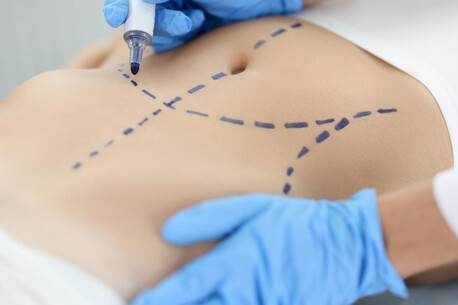 New Delhi, Health, Liposuction Surgery In Delhi - Sculpt Your Ideal Body