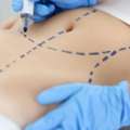 Liposuction Surgery In Delhi - Sculpt Your Ideal Body