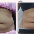 Liposuction Surgery Cost In Delhi - Dr Rajat Gupta