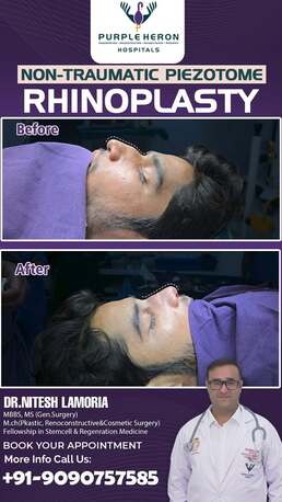 Jaipur, Health, Best Plastic Surgeon In Jaipur - Dr. Nitesh Lamoria