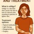 Vitiigo Treatment In Visakhapatnam