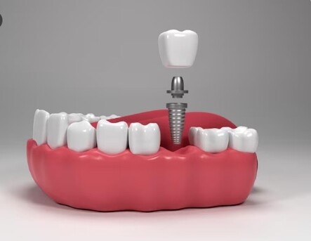 New York, Dental, Premium Beverly Hills Dental Implants For A Natural, Confident Smile