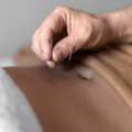 Acupuncture For Weight Loss &ndash; Safe And Natural Body Slimming