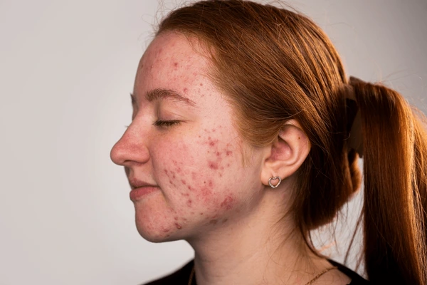 New York, Health, Gentle Daily Cleanser For Breakout-Prone Skin