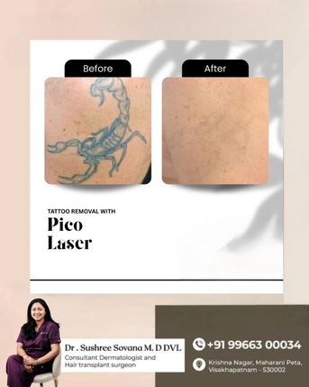 Visakhapatnam, Health, Tattoo Removal Treatment In Vizag  Derma One Clinic