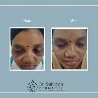 Kurnool, Health, Best Dark Circles Treatment At Dermacure By Dr Sahitya Reddy