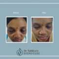 Best Dark Circles Treatment At Dermacure By Dr Sahitya Reddy