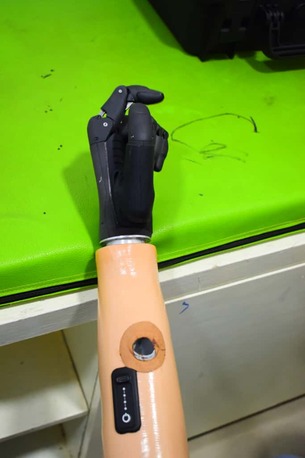 Hyderabad, Health, Free Artificial Leg In Hyderabad | CareVale Prosthetics