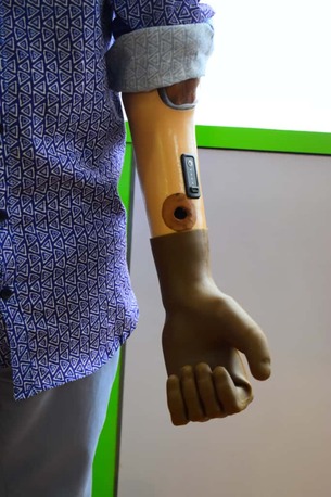 Hyderabad, Health, Free Artificial Leg In Hyderabad | CareVale Prosthetics