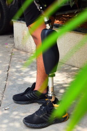 Hyderabad, Health, Free Artificial Leg In Hyderabad | CareVale Prosthetics