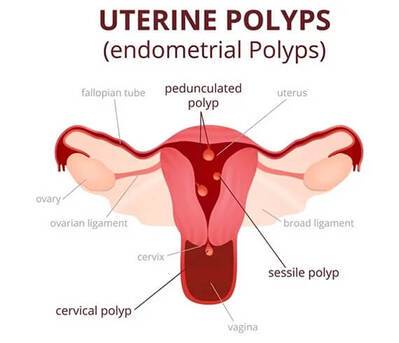 New Delhi, Health, Hysteroscopy Procedure In Delhi - Dr Rhythm Gupta